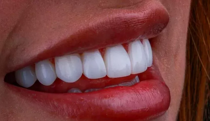 معایب ایمپلنت زیرکونیا