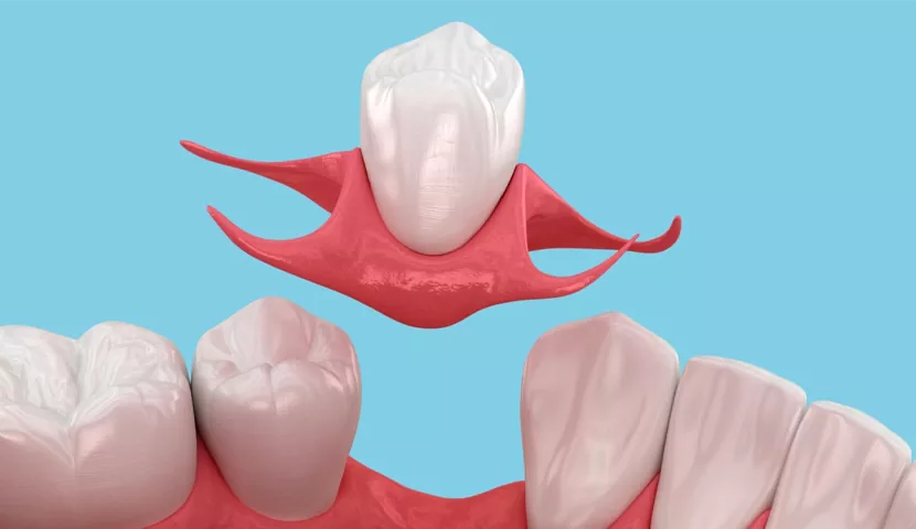 معایب فیلپر تک‌ دندان